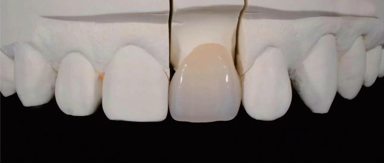 Aesthetic glass ceramic veneer matching natural teeth
