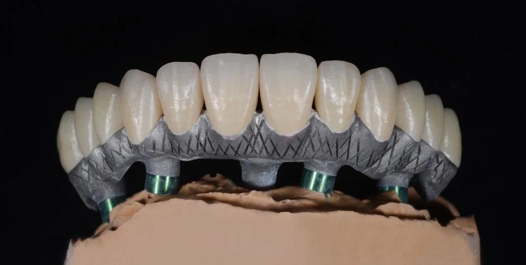 All-ceramic implant restoration on a titanium framework