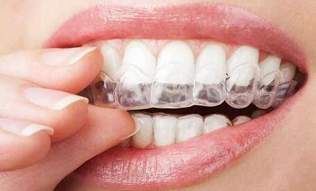 Clear orthodontic aligner in use